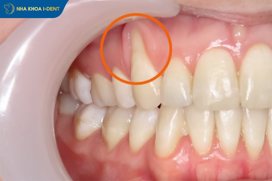 niềng răng bị ê khi uống nước