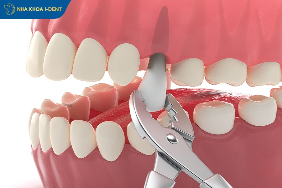 niềng răng có bị hóp thái dương không