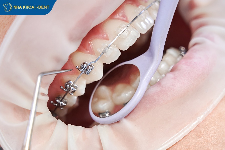 niềng răng có làm răng yếu đi không