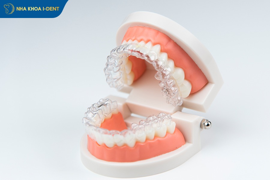 niềng răng không mắc cài