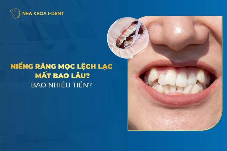 Niềng Răng Mọc Lệch Lạc Mất Bao Lâu? Bao Nhiêu Tiền?