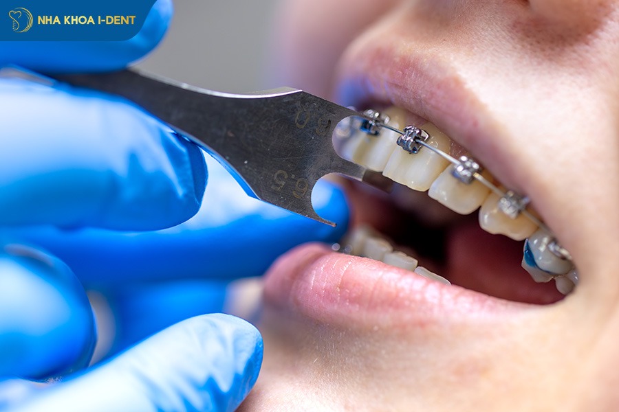 mắc cài kim loại thường và tự buộc