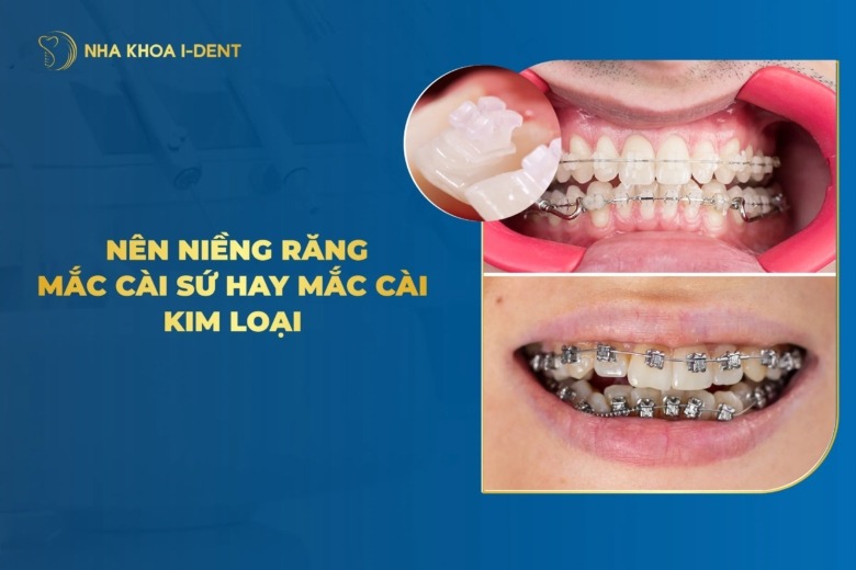 So sánh niềng răng mắc cài sứ và kim loại chọn loại nào?