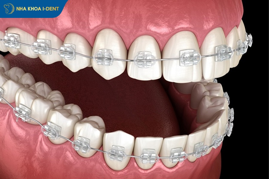 niềng răng mắc cài sứ và kim loại