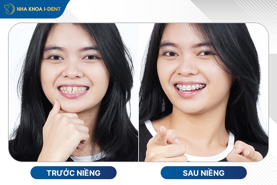 niềng răng lệch lạc