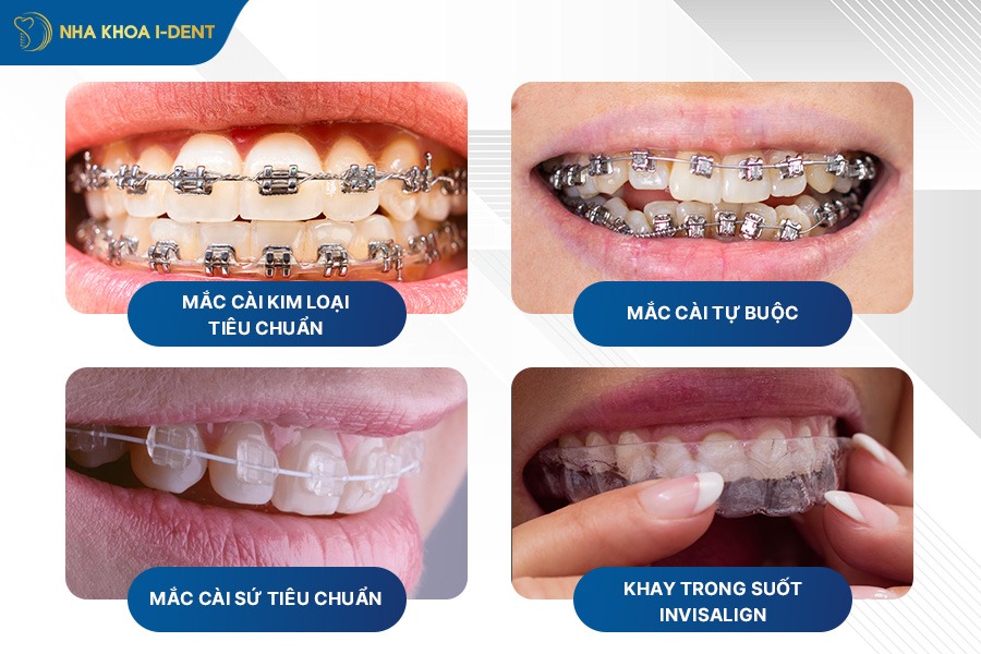 niềng răng mọc lệch giá bao nhiêu