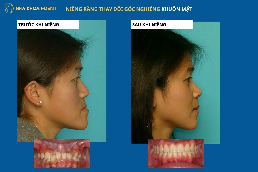 niềng răng thay đổi góc nghiêng