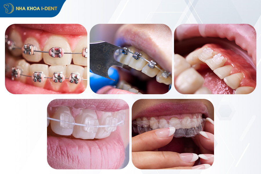 niềng răng thay đổi như thế nào