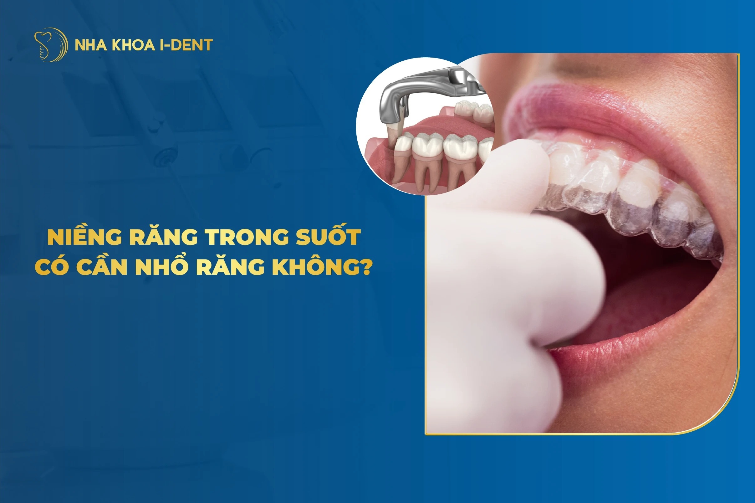 Niềng Răng Trong Suốt Có Cần Nhổ Răng Không?