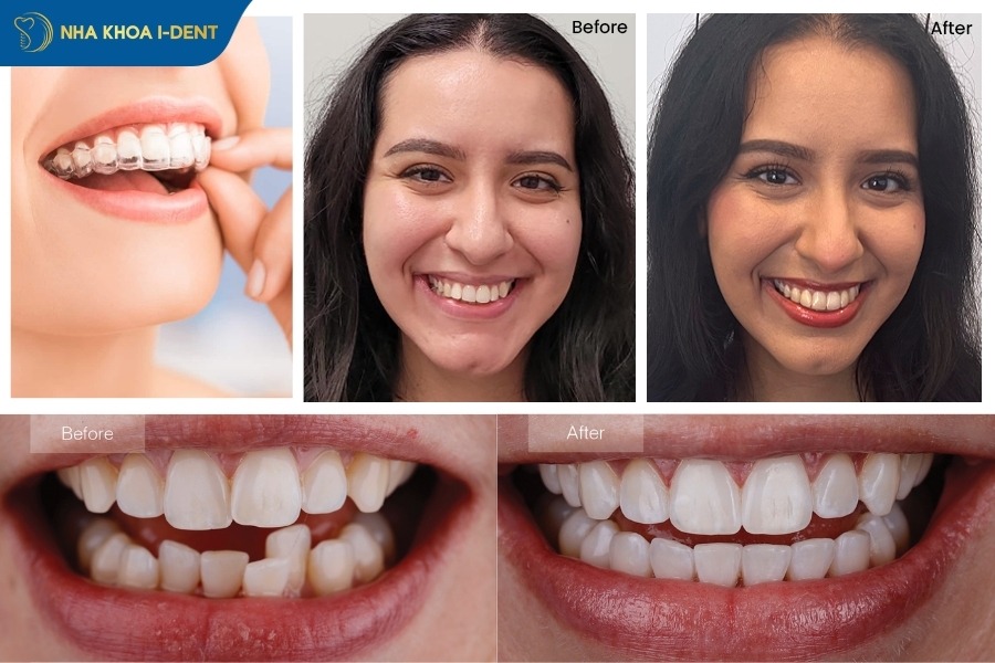 niềng răng trong suốt có hiệu quả