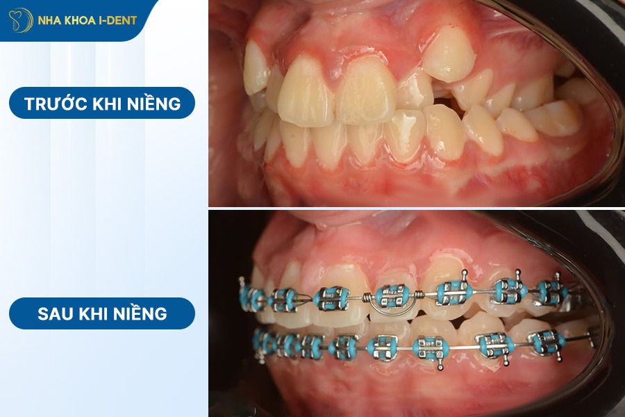niềng răng trước và sau
