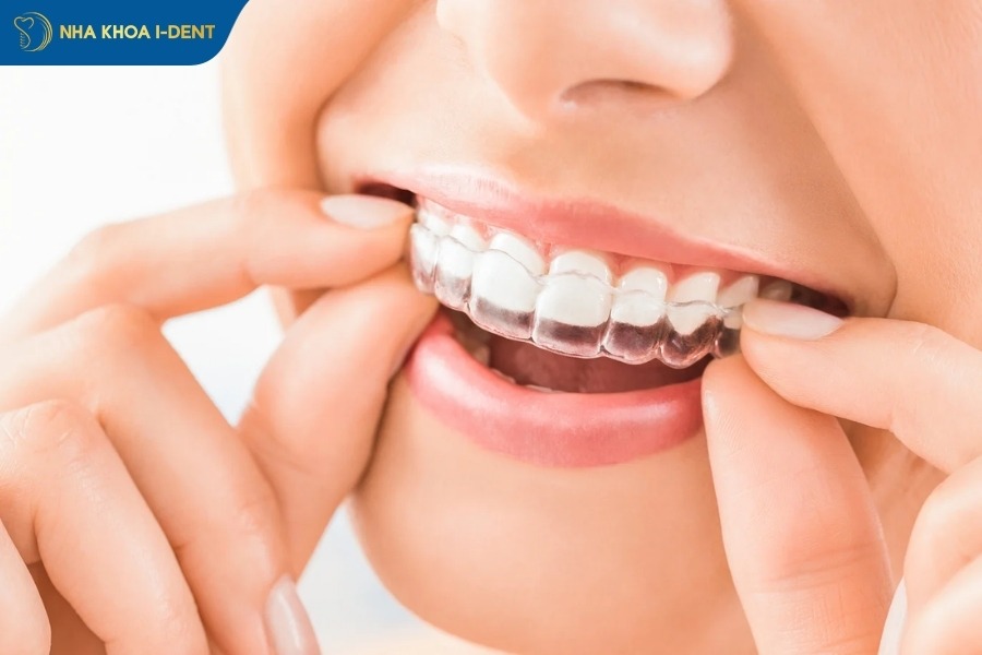 niềng trong suốt