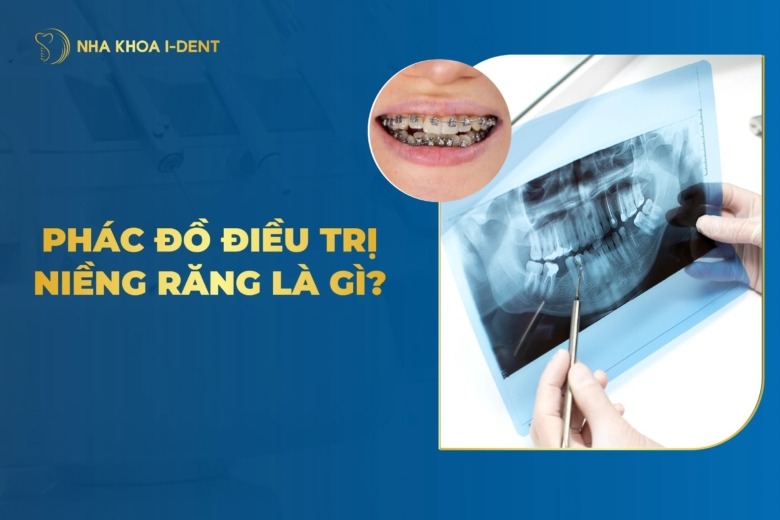 Phác đồ niềng răng cá nhân hóa là gì? 7 Bước chi tiết
