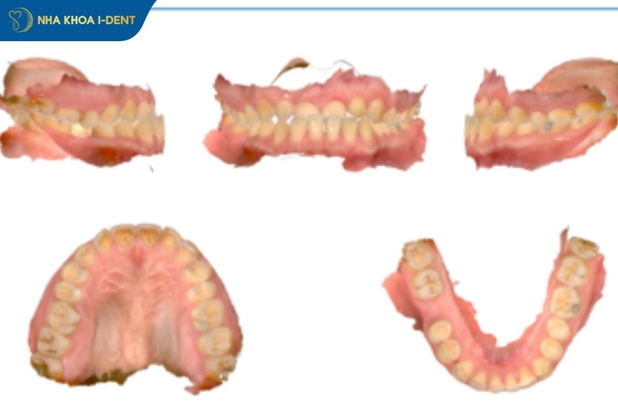 Phân tích khớp cắn và không gian