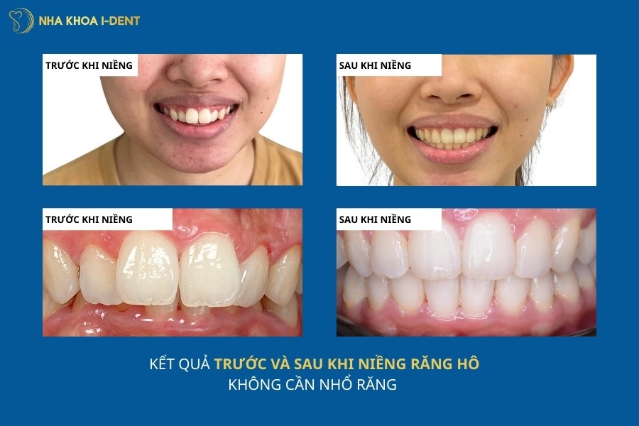 trước và sau khi niềng răng hô không nhổ răng