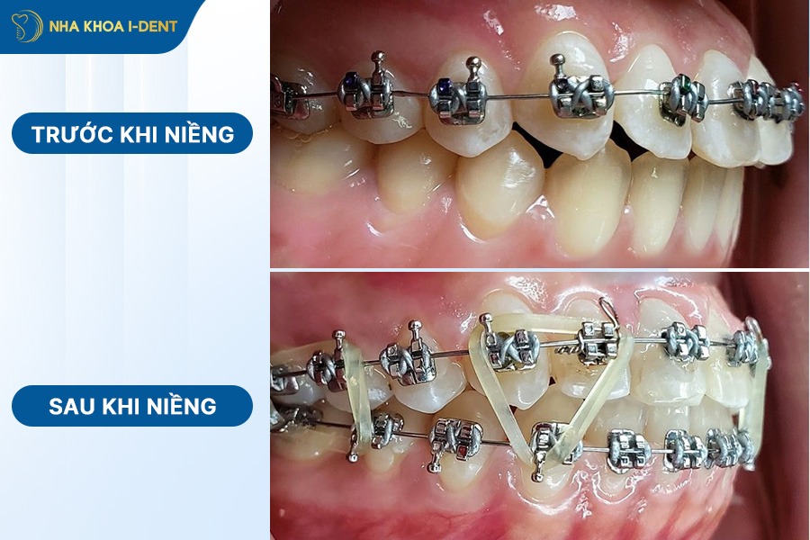trước và sau khi niềng răng hô
