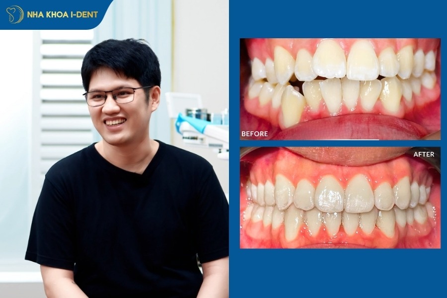 trước và sau khi niềng răng trong suốt