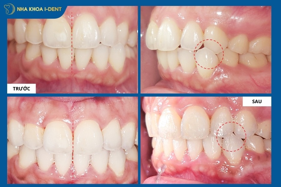 trước và sau niềng răng trong suốt