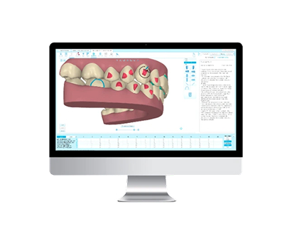 Clincheck Software – 3D Tooth Movement Simulation