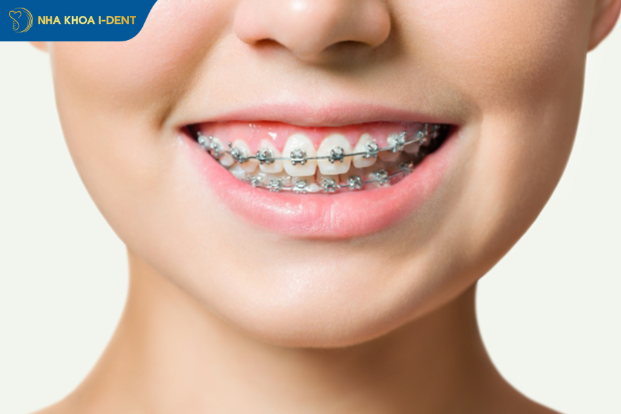 20 tuổi niềng răng bao nhiêu tiền