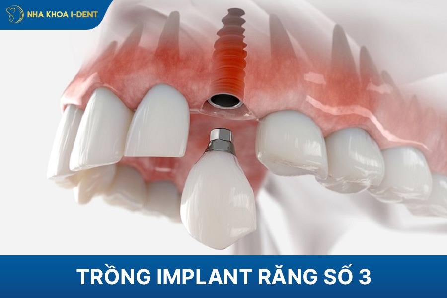 trồng implant răng số 3