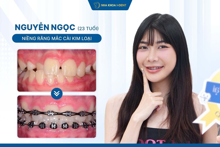Hành Trình Niềng Răng Bạn Nguyễn Ngọc: Thay Đổi Nụ Cười, Thay Đổi Cuộc Sống