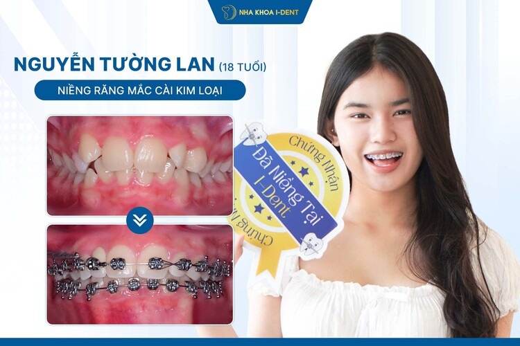 Hành Trình Niềng Răng Bạn Tường Lan: Chỉnh Răng Thưa, Cân Lại Nhân Trung
