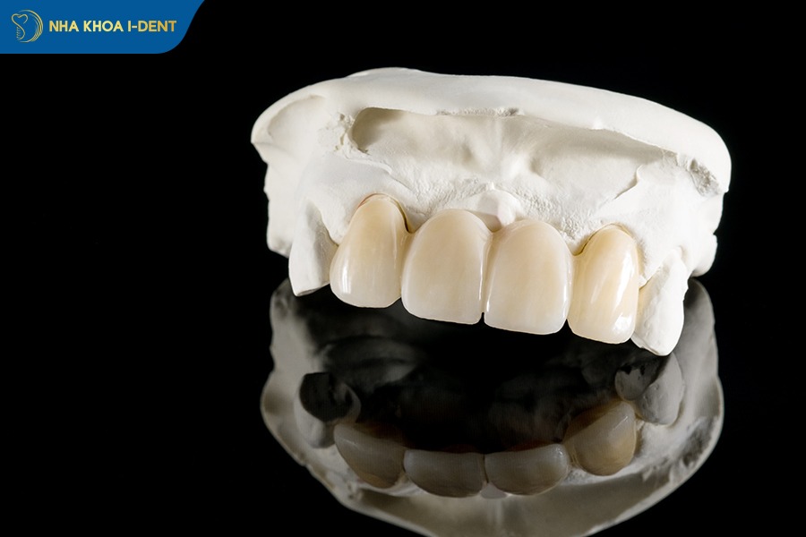 bọc răng sứ titan được bao lâu