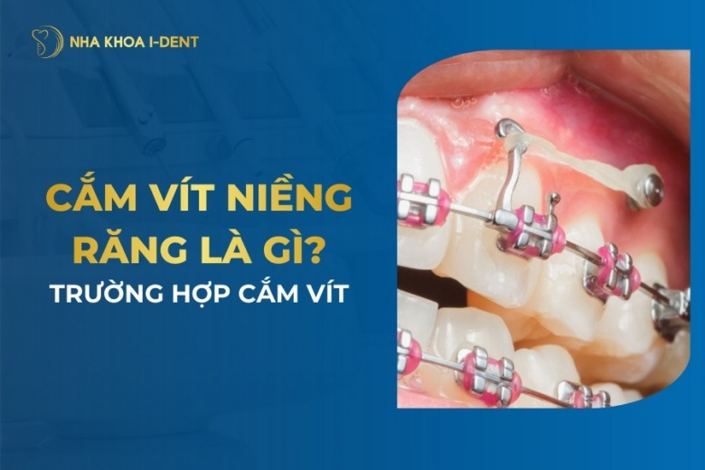 Cắm Vít Niềng Răng Là Gì? Trường Hợp Cắm Vít