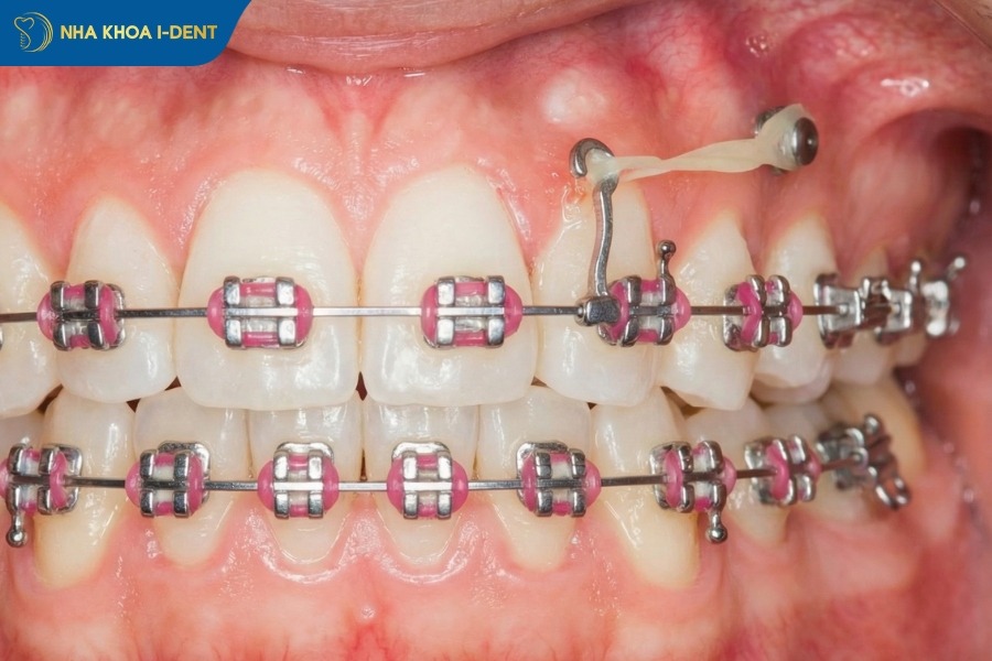 cắm vít niềng răng là gì