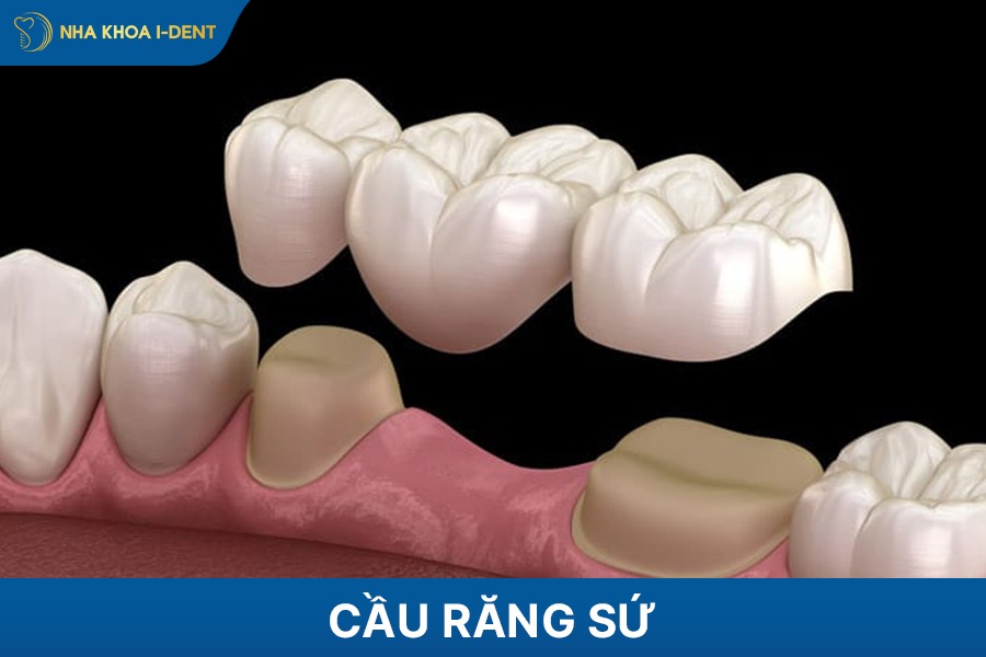 cầu răng sứ