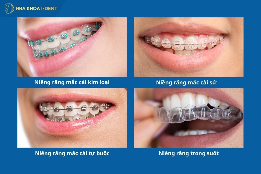 chăm sóc răng miệng sau niềng