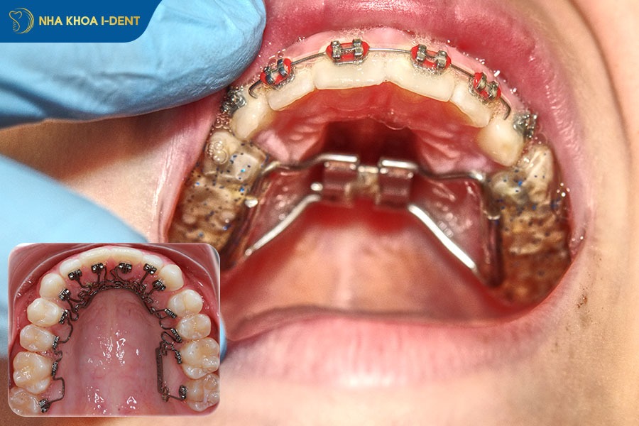 Chi phí niềng răng cho người lớn bằng mắc cài mặt trong