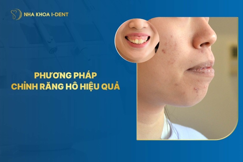 4 Phương Pháp Chỉnh Răng Hô Hiệu Quả