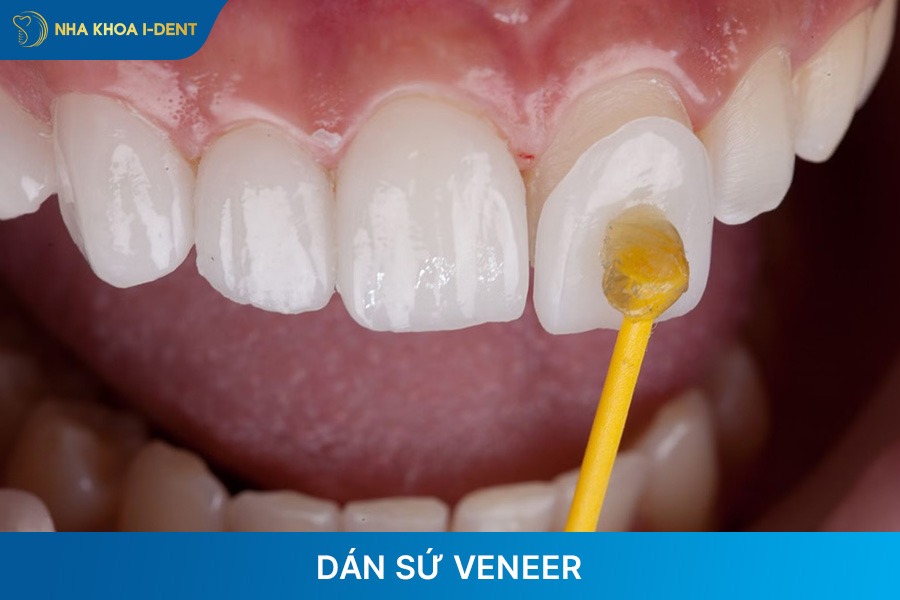 chỉnh răng hô bằng phương pháp dán sứ veneer