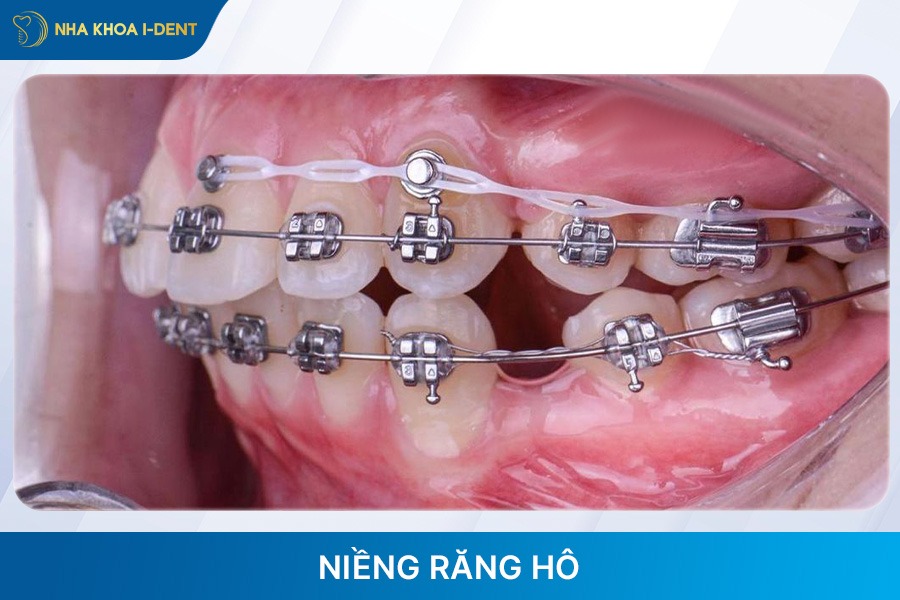 chỉnh răng hô bằng phương pháp niềng răng