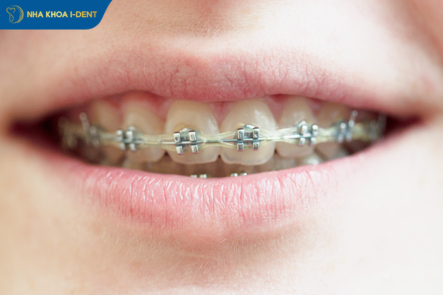 đeo thun niềng răng