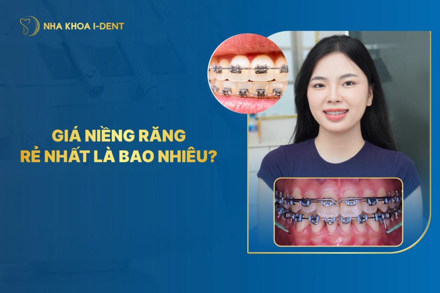 Niềng Răng Rẻ Nhất Giá Bao Nhiêu? Bảng Giá Mới Nhất