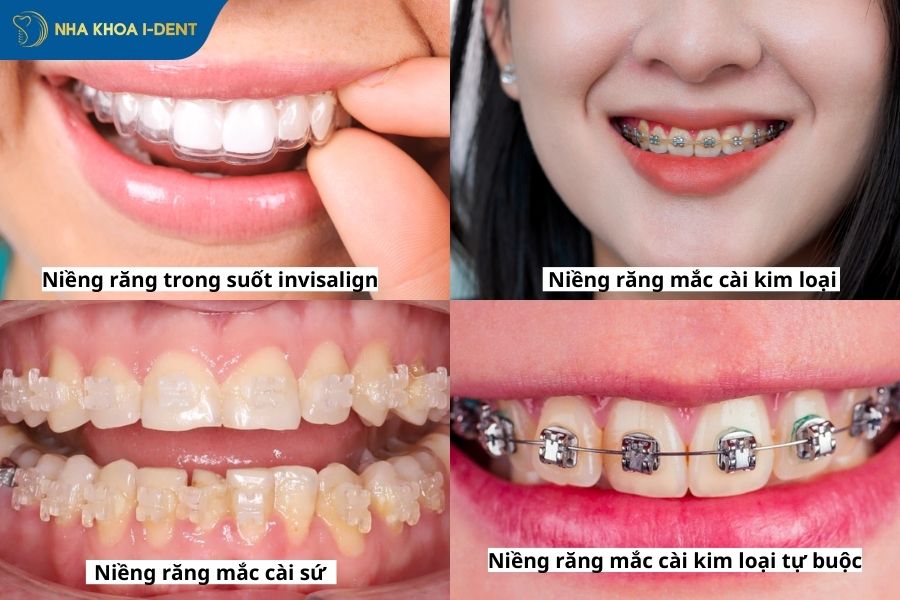 niềng răng đau cách giảm