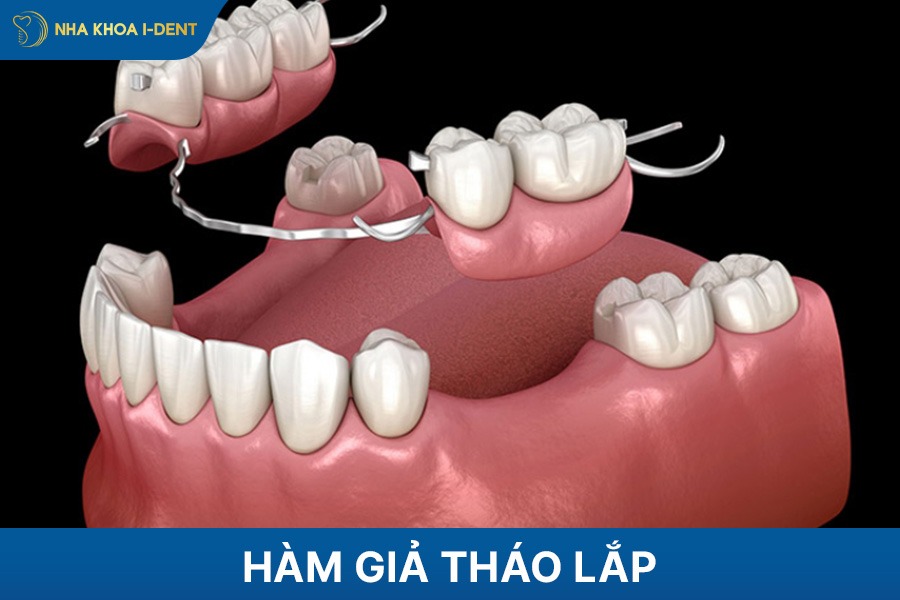 hàm giả tháo lắp