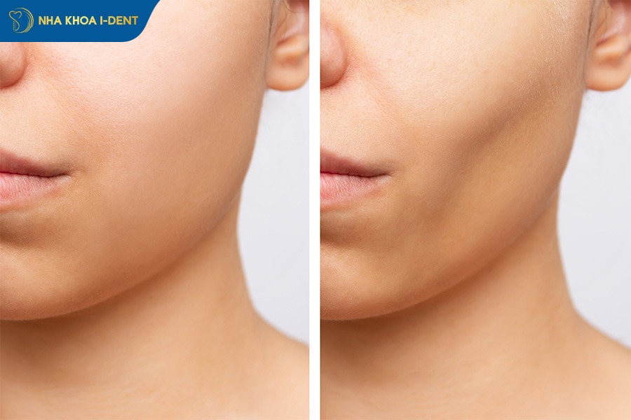 hóp má gây mất thẩm mỹ khuôn mặt