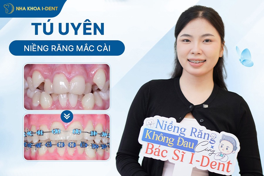 khách hàng niềng răng tại Nha khoa I-Dent
