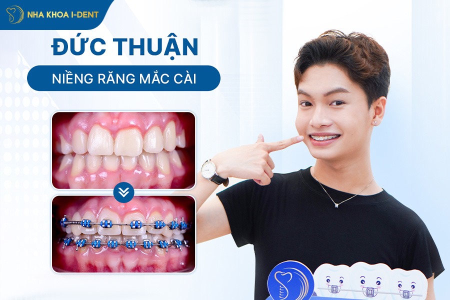 khách hàng niềng răng tại Nha khoa I-Dent.