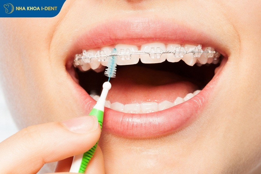 kinh nghiệm niềng răng trong suốt