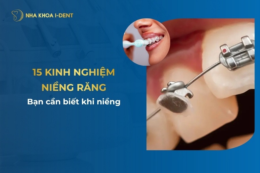 15 kinh nghiệm niềng răng bạn cần biết khi niềng