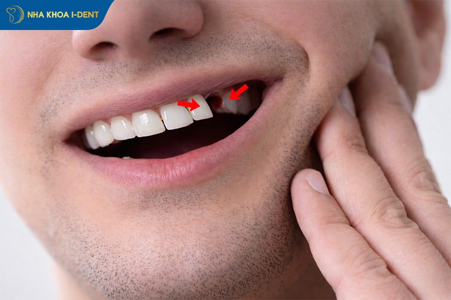 làm xô lệch các răng kế cận