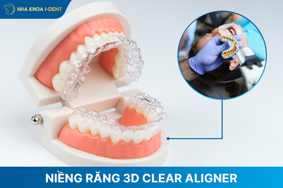 loại niềng răng trong suốt hiện đại