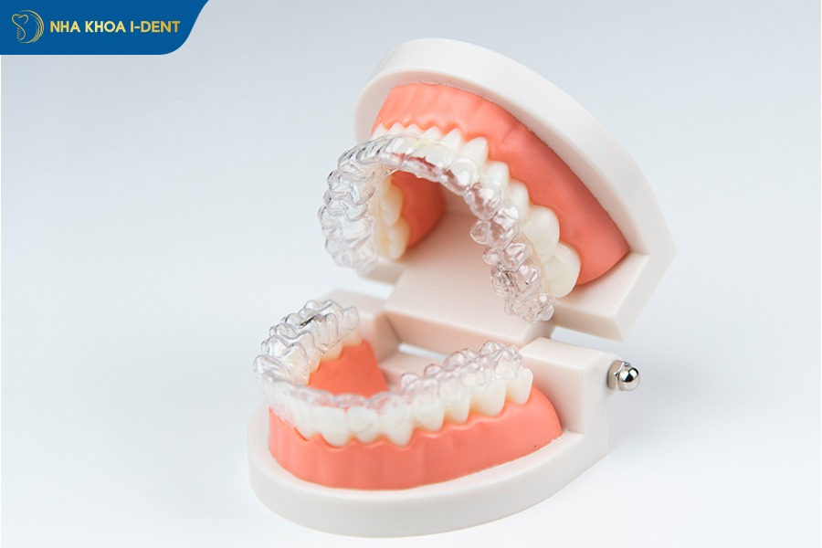 máng niềng răng tại nhà