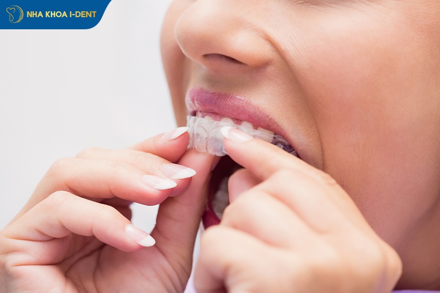 máng niềng răng trong suốt