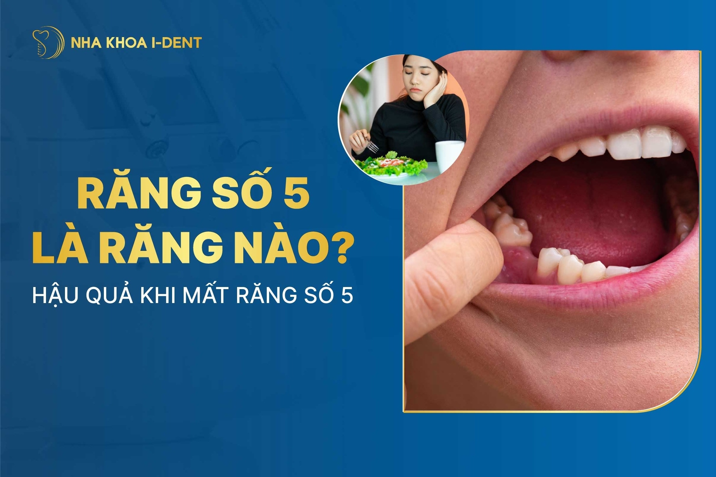 Răng số 5 là răng nào? Hậu quả khi mất răng số 5